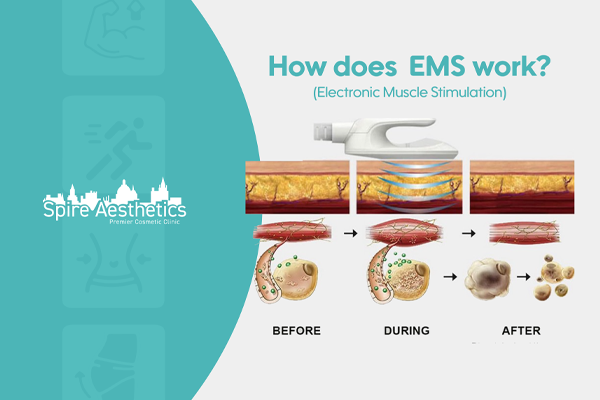 EMS treatment for post pregnancy weight loss treatment Ladymoor