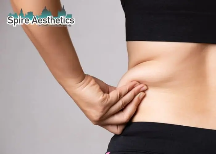 Image of woman pinching fat on their hips Ladymoor. Fat Freezing treatment