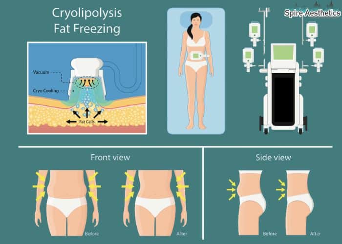 Image of diet and fat freezing combined for best results for Spire Aesthetics Ladymoor