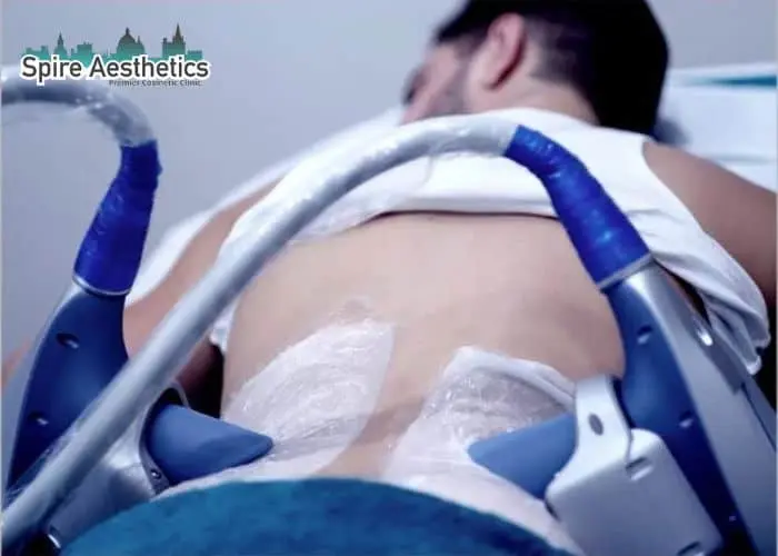 Man having fat freezing treatment done on love handles before a competitions Ladymoor to create a sculpted look.