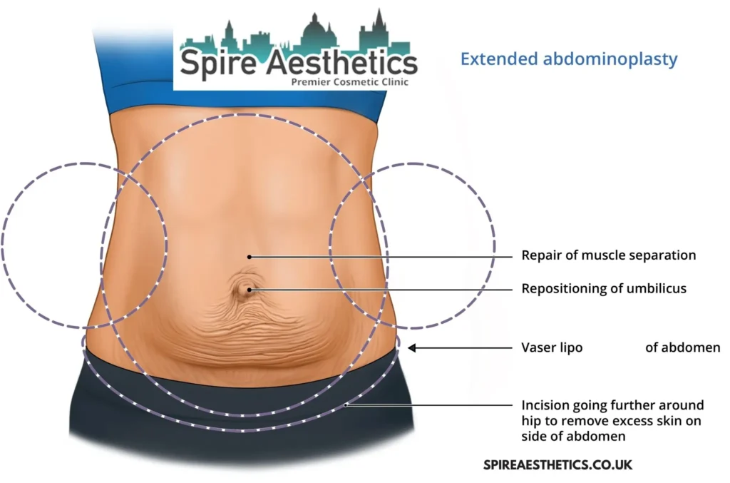 Understanding Loose Skin After Gastric Band Ladymoor Surgery and HIFU Treatment
