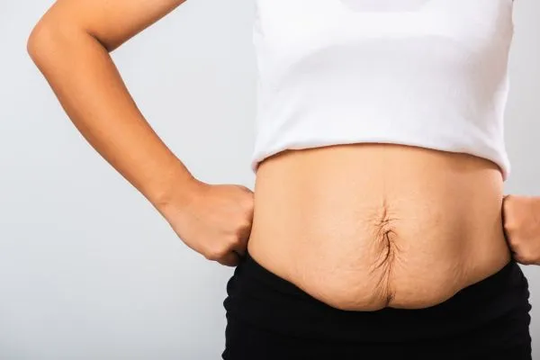 Image of a woman's stomach after weight loss with sagging skin following a gastric band Ladymoor