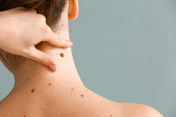 skin blemish removal Ladymoor treatment